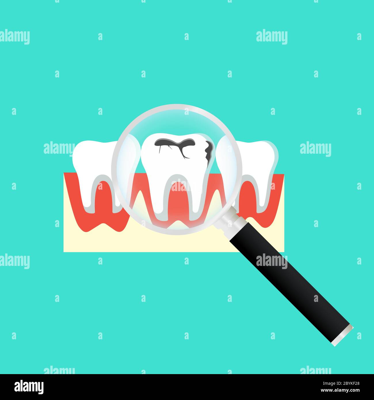 Carie problemi dentali. Icona dente con carie con lente di ingrandimento. Grande foro nei denti umani su sfondo isolato. Vettore EPS 10. Illustrazione Vettoriale