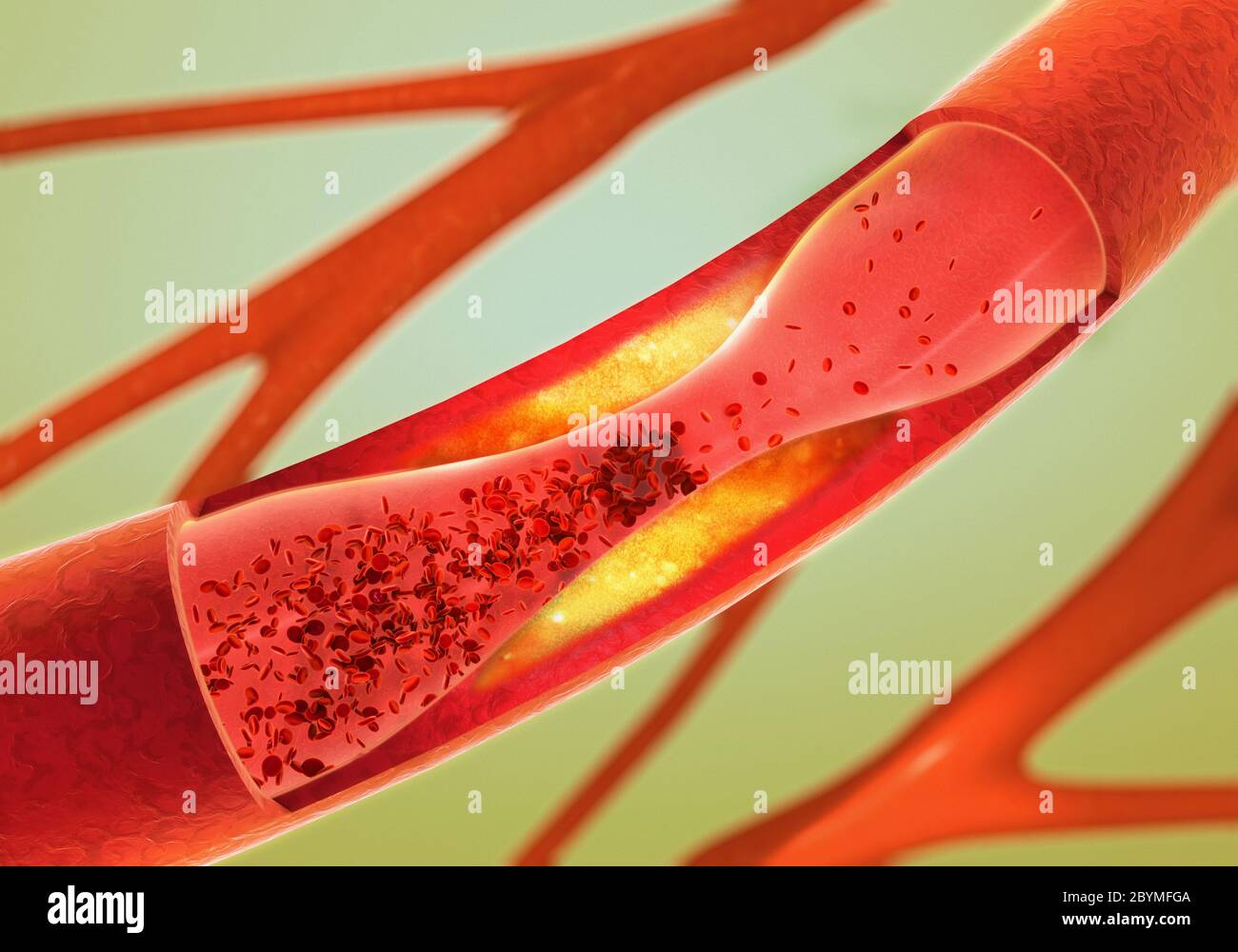 Precipitato e restringimento dei vasi sanguigni - arteriosclerosi Foto Stock