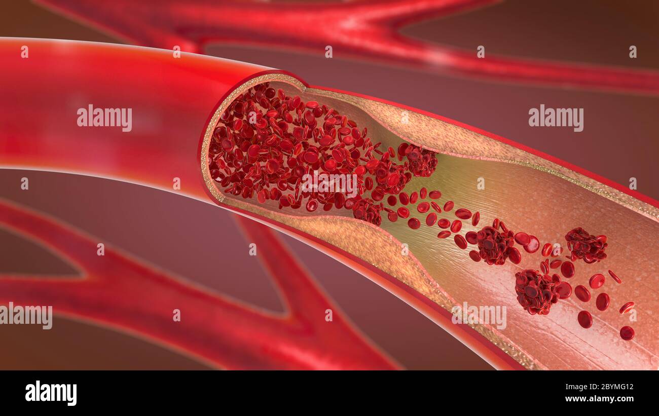 3d illustrazione di un ristretto e arteria ristretta e il sangue può fluire correttamente chiamato arteriosclerosi Foto Stock