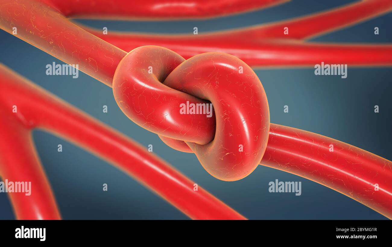 3d illustrazione di un nodo in una arteria ristretta ristretta e chiamato arteriosclerosi Foto Stock