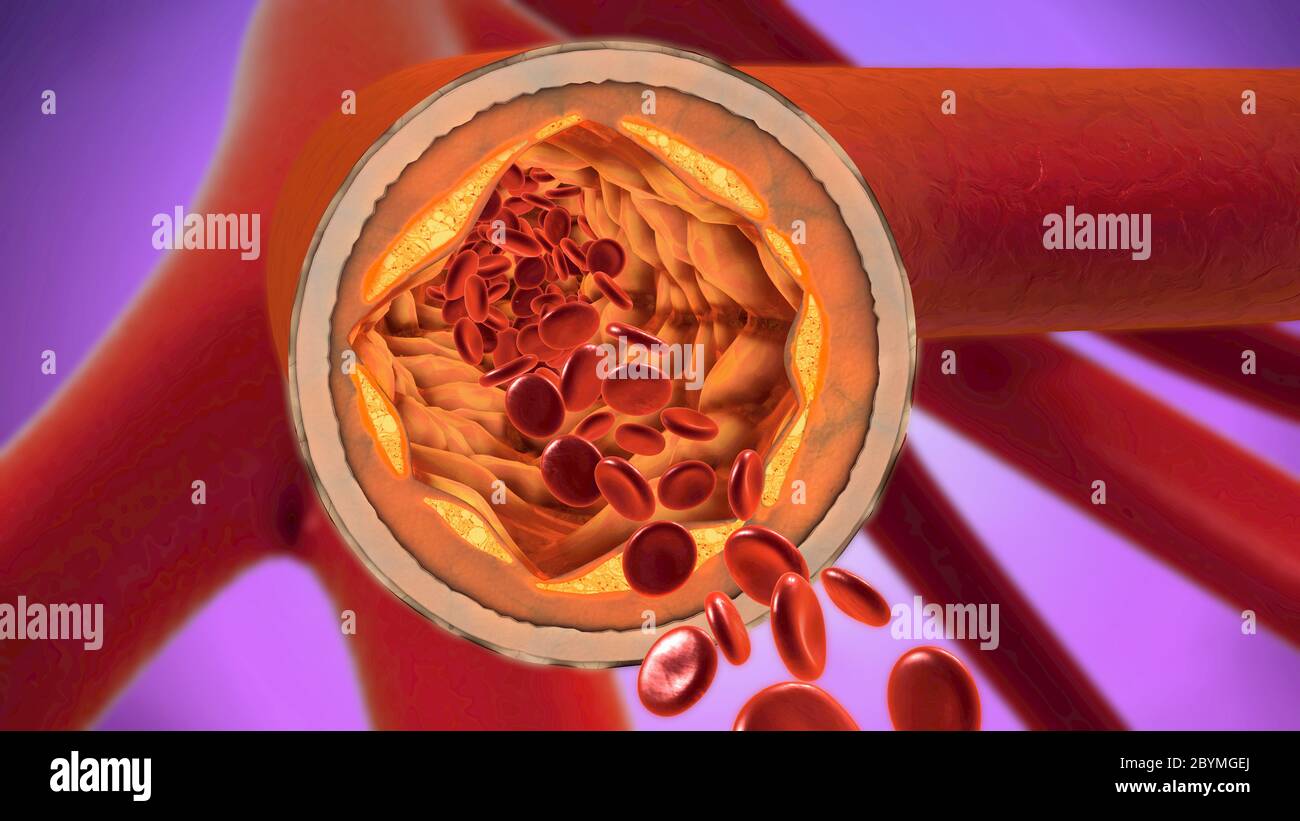 3d illustrazione di un precipitato e restringimento dei vasi sanguigni o arteriosclerosi Foto Stock