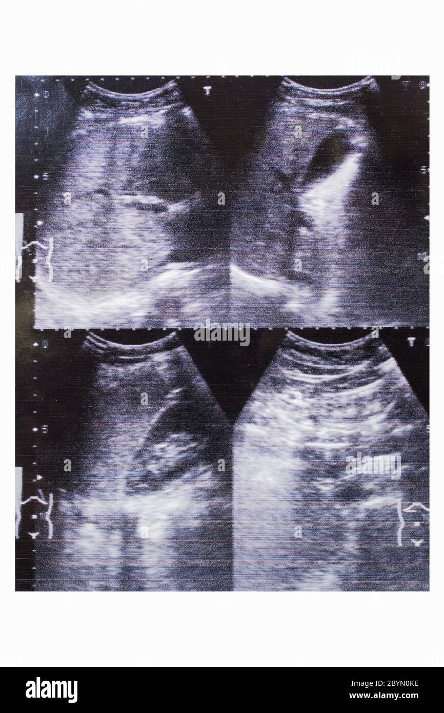 immagine ecografica stampata della cistifellea, infiammazione epatica della donna Foto Stock