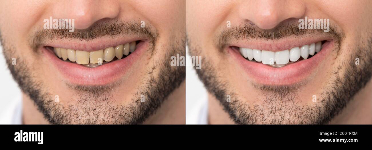 Denti prima e dopo l'imbiancamento. Concetto di cura dentale Foto Stock