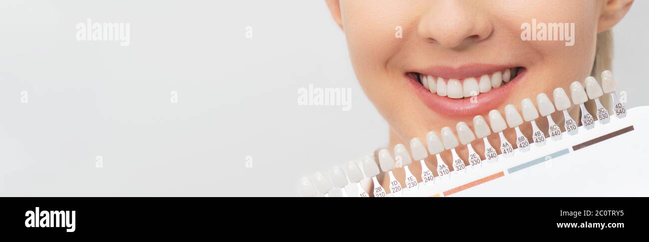 Processo di sbiancamento dei denti. Set di impianti con varie tonalità di tono. Cura dentale. Foto Stock