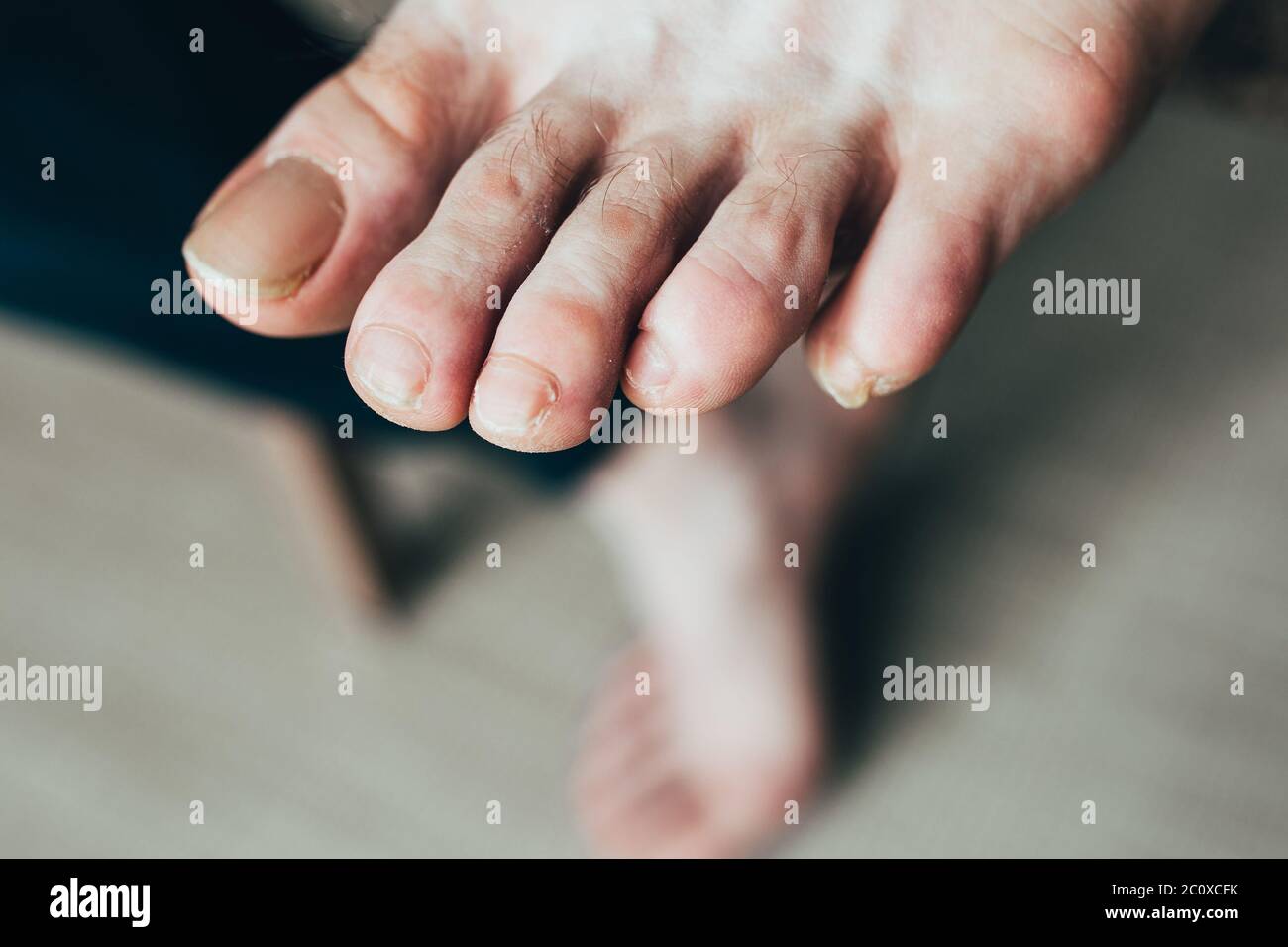 chiodi deboli sporchi e rotti sul piede maschio - danni e incrinature sui chiodi Foto Stock