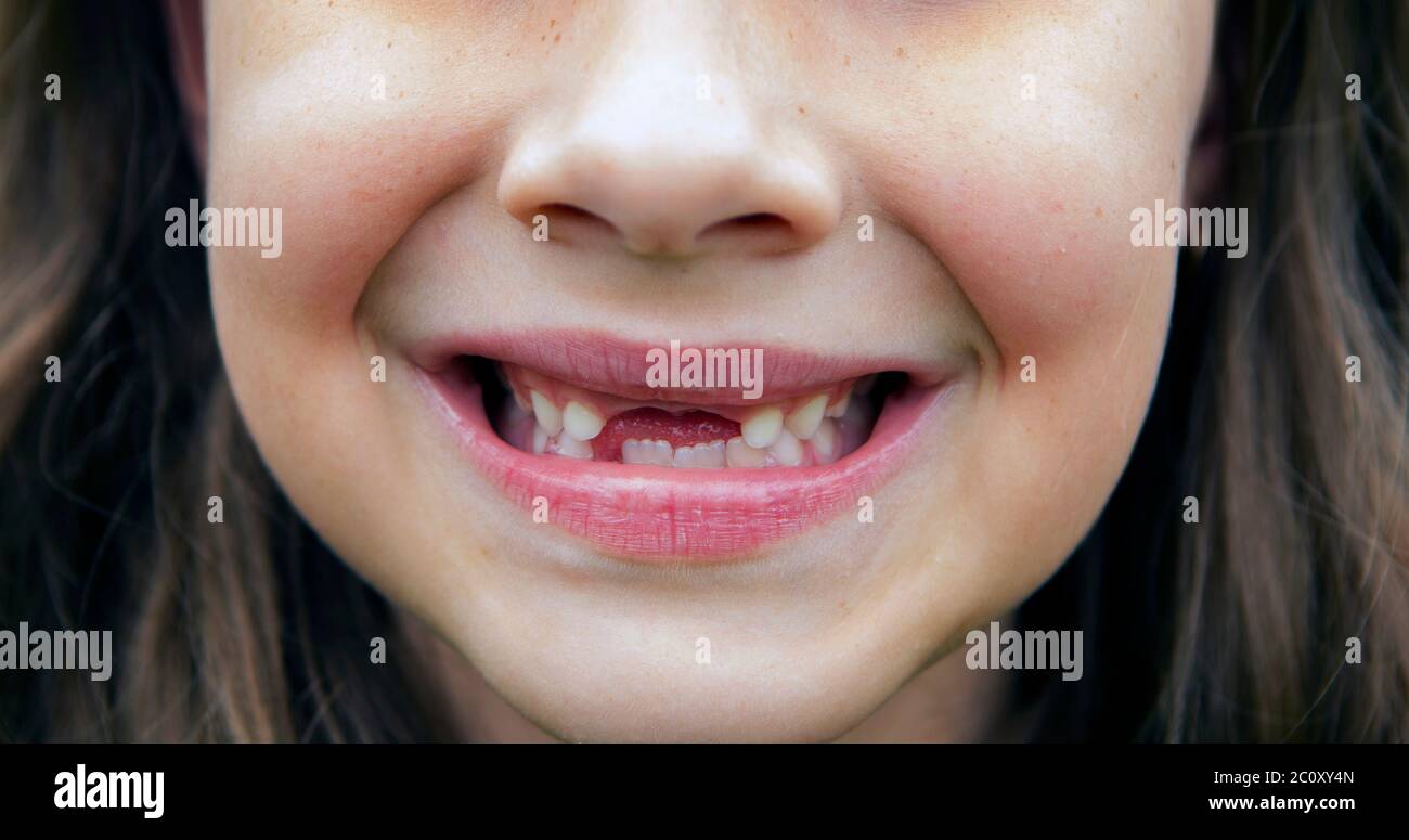 Bruna ragazza sorridente e mostrante i denti anteriori mancanti Foto Stock