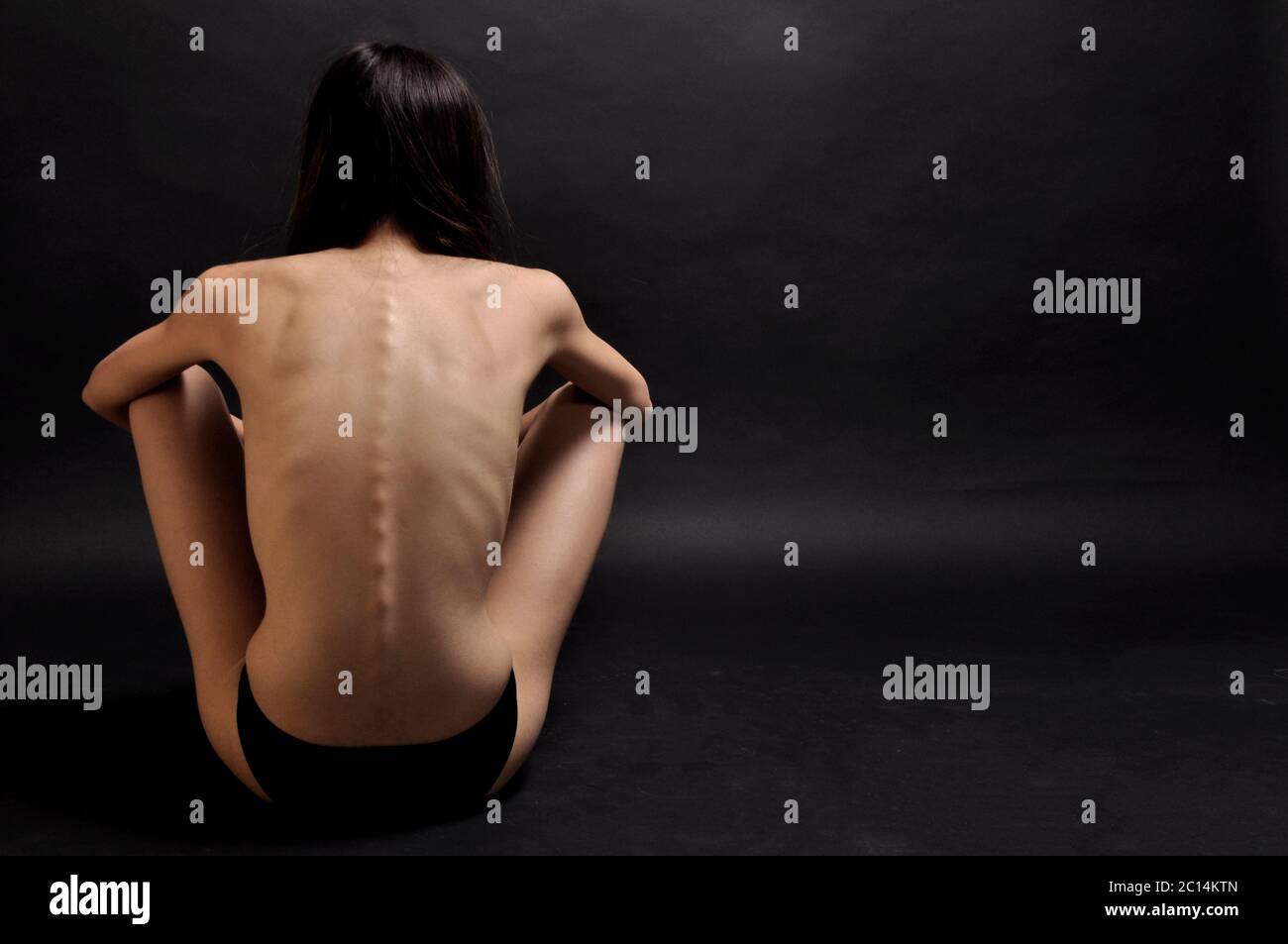 Depresso 18 anni femmina anorettica teen con ritorno a macchina fotografica su sfondo nero. Versione del modello disponibile Foto Stock