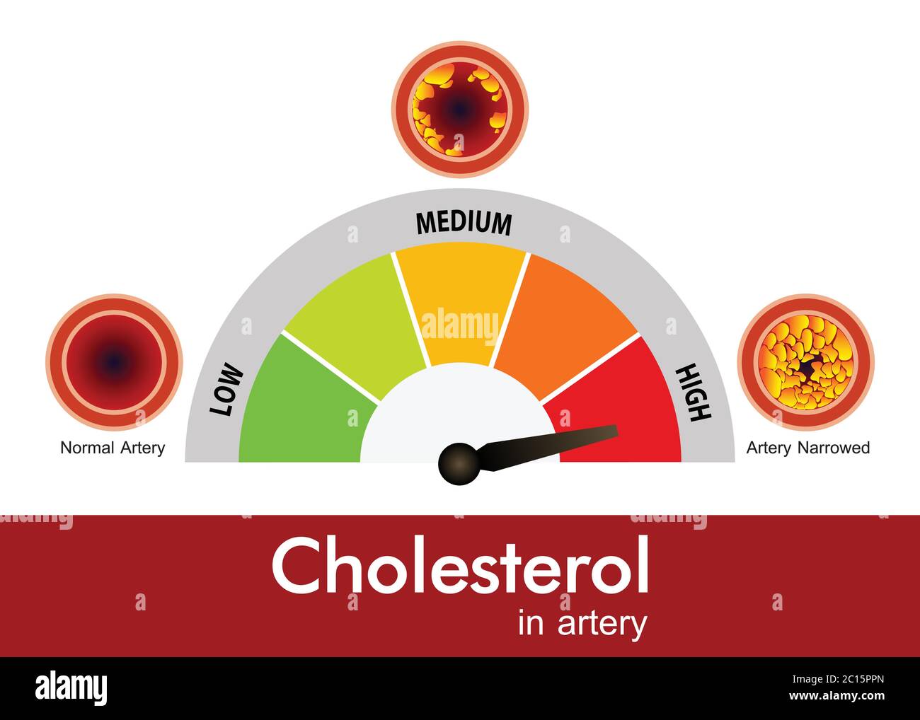 Colesterolo in arteria, rischio per la salute, disegno vettoriale Illustrazione Vettoriale
