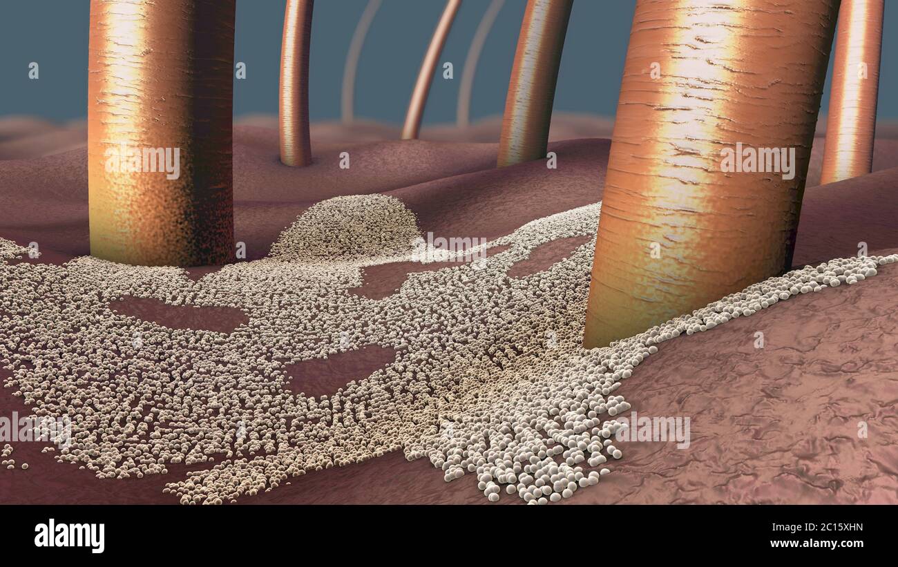 Microscopico primo piano di un'infezione fungina dello strato superiore della pelle, chiamata micosi della pelle - illustrazione 3d Foto Stock
