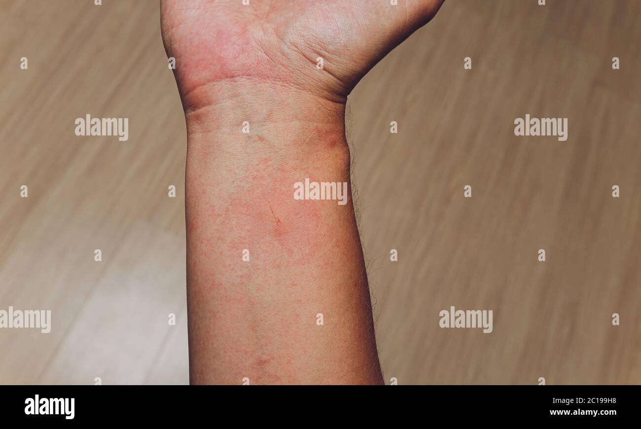 Vesciche rosse sulla mano e dermatite, prurito da allergie, malattie della  pelle o insetti, morso di animali velenosi Foto stock - Alamy