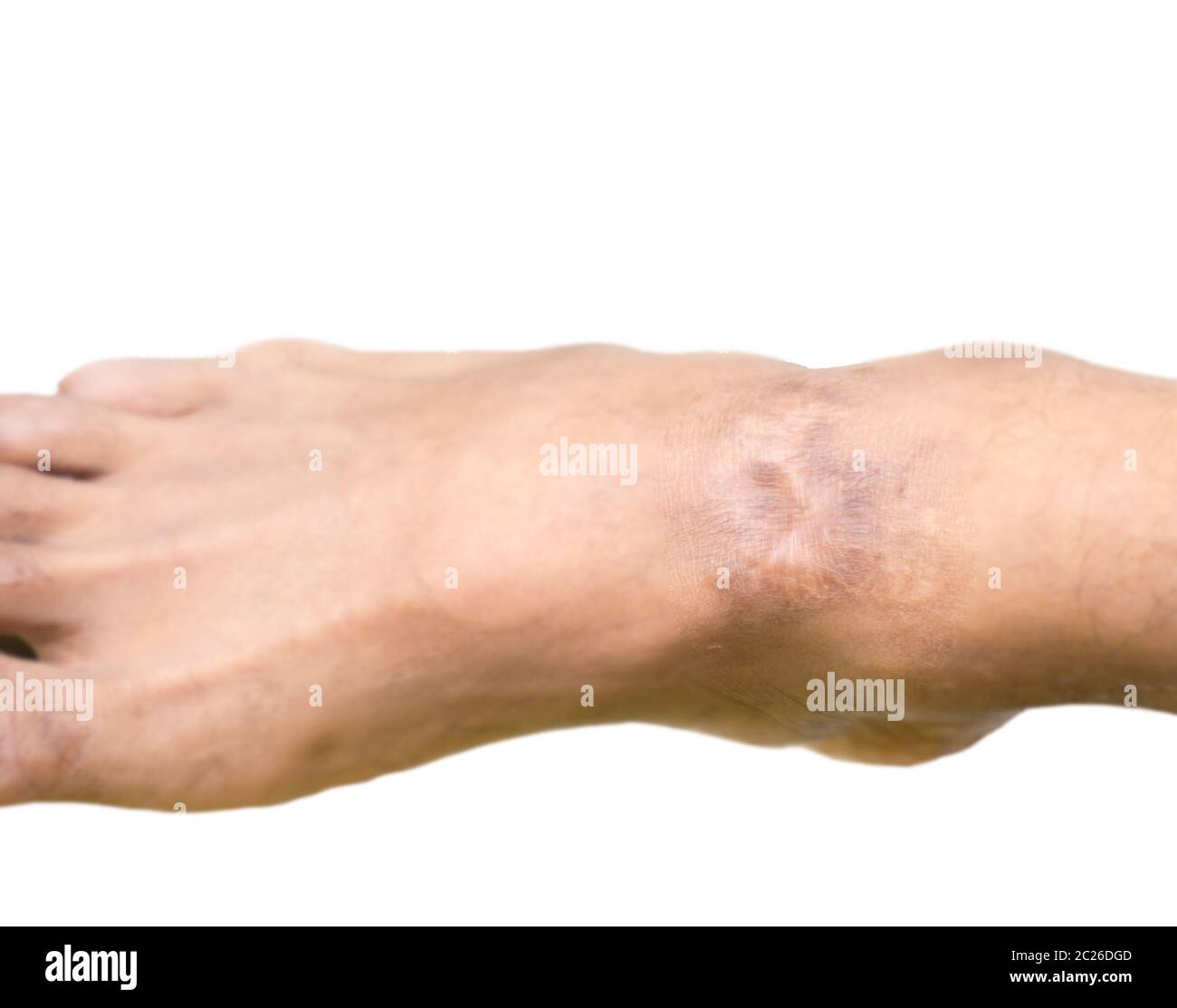 Closeup keloid cicatrice sulla caviglia della pelle asiatica dell'uomo dopo un incidente motociclistico su sfondo bianco con spazio di copia. Foto Stock