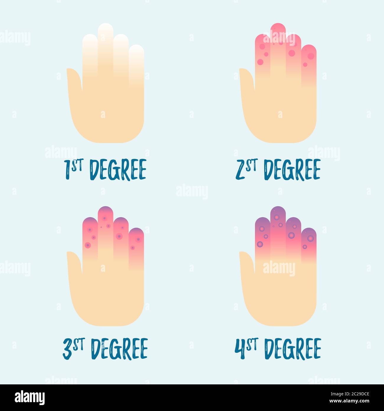 Tavole da congelamento. Mani congelate con le dita. Ipotermia. Illustrazione Vettoriale