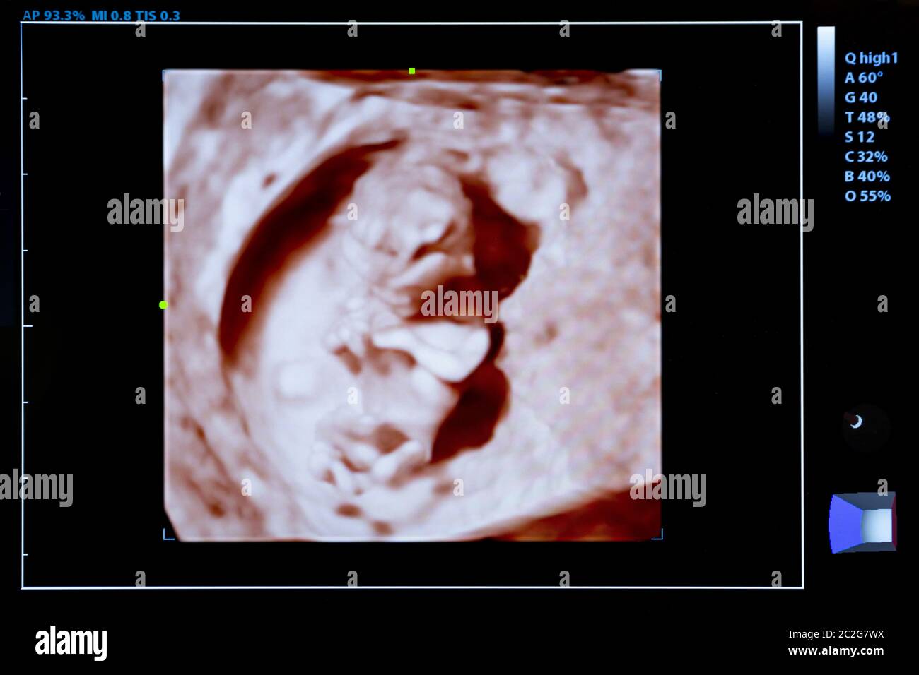 Immagine colorata di gravidanza monitor ad ultrasuoni Foto Stock