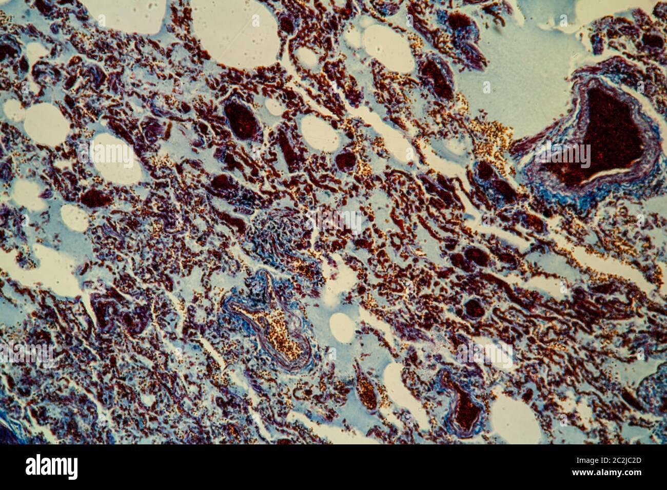 Influenza tessuto polmonare al microscopio 100x Foto Stock