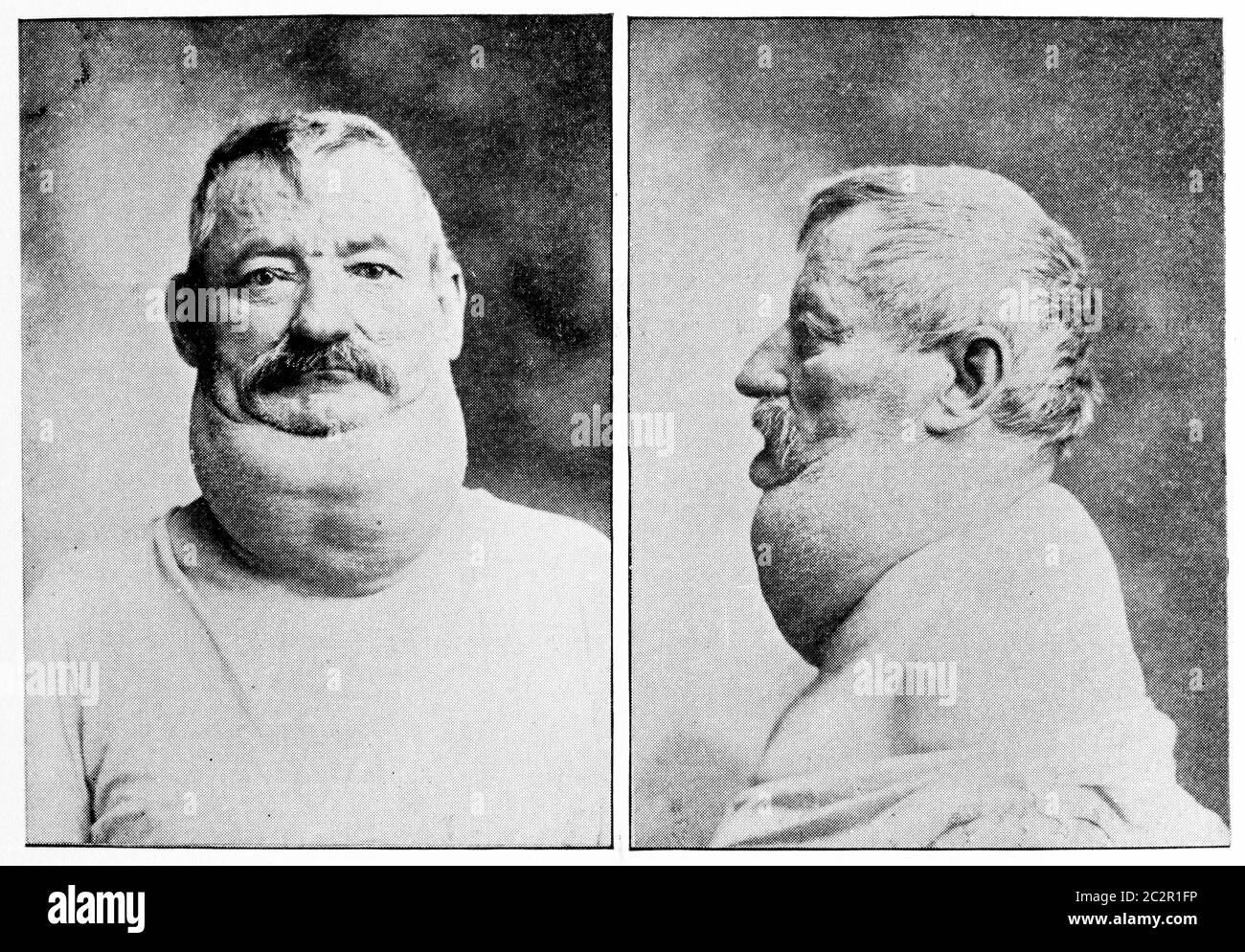Lipoma diffuso del collo, illustrazione vintage incisa Foto stock - Alamy
