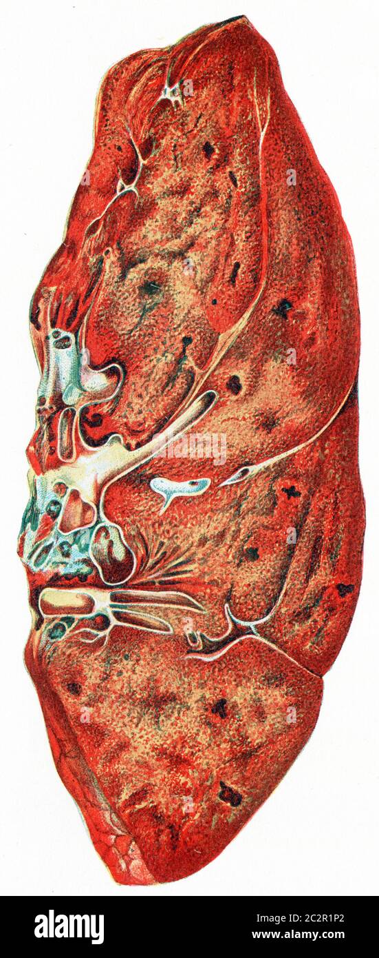 Polmone, polmonite croupious, illustrazione vintage incisa. Foto Stock