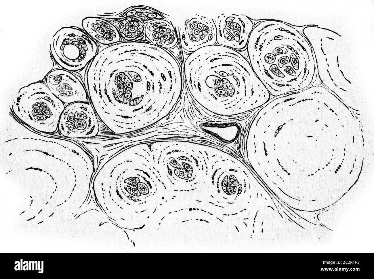 Cancro colloide, illustrazione vintage incisa. Foto Stock