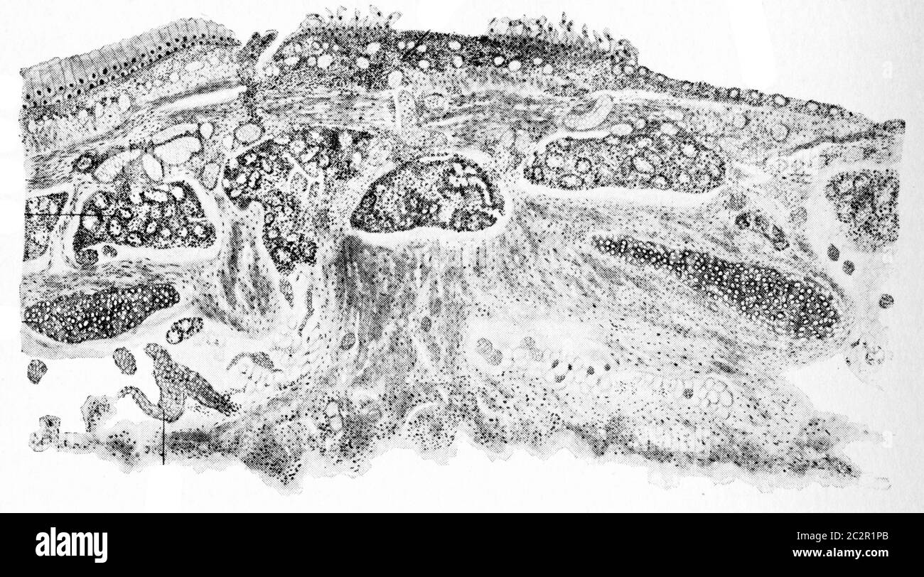 Sezione di parete di bronco, bronchite cronica, illustrazione d'annata incisa. Foto Stock