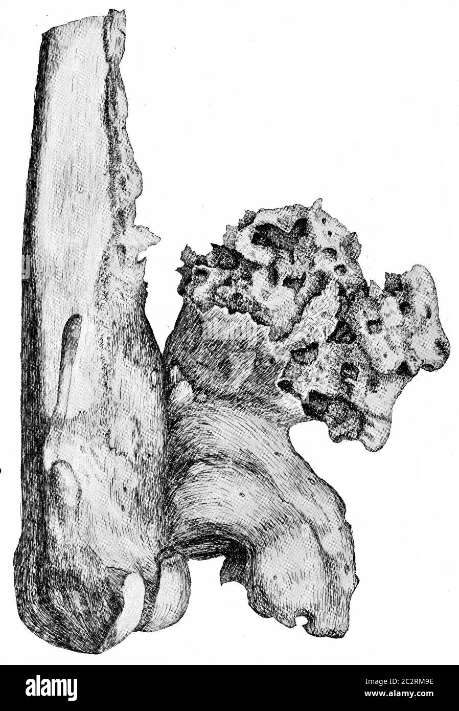 Osteofiti sull'aspetto popliteo dell'estremità inferiore del femore, illustrazione vintage incisa. Foto Stock