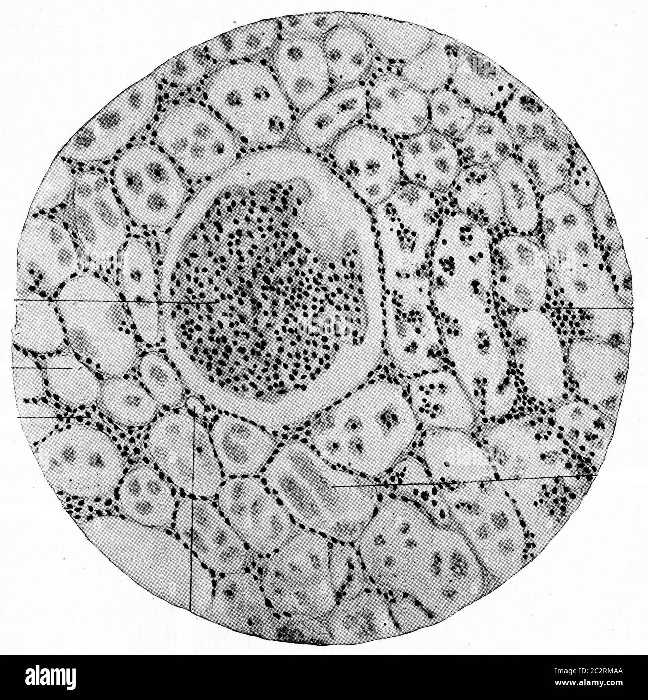 Nefrite parenchimatica cronica, illustrazione vintage incisa. Foto Stock