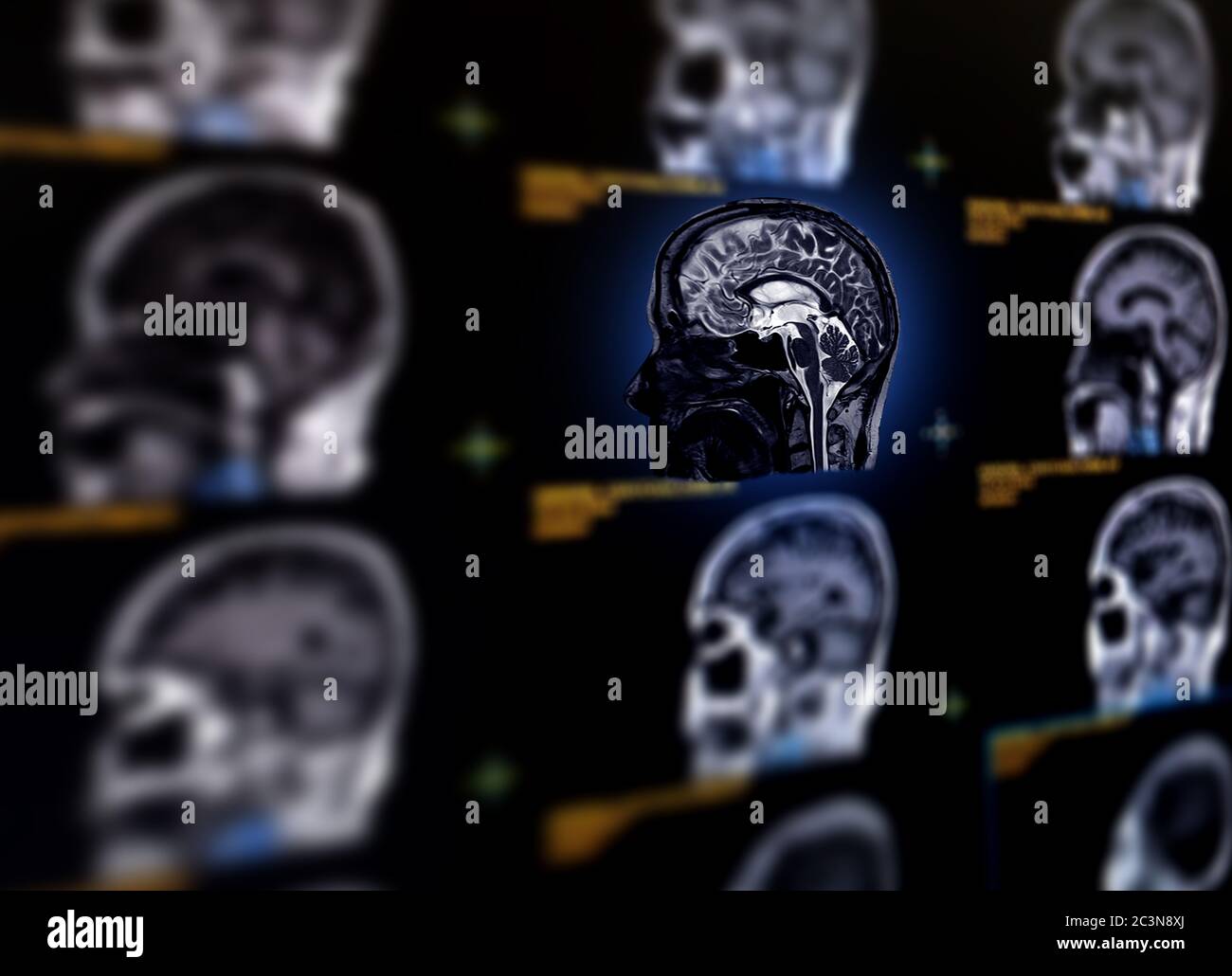 Fuoco selettivo del piano sagittale cerebrale MRI per rilevare una varietà di condizioni del cervello come cisti, tumori, sanguinamento, gonfiore, sviluppo A. Foto Stock