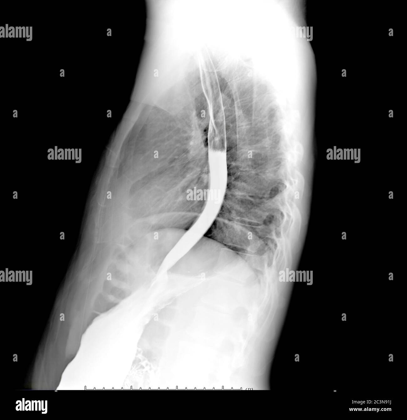 Esofagramma o bario deglutire la vista laterale che mostra l'esofago. Foto Stock