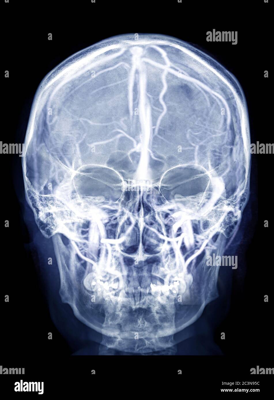 Immagine radiografica del cranio del cranio umano combinazione di vista AP con immagine MRV Brain che mostra i seni venosi del cervello nel cranio. Foto Stock