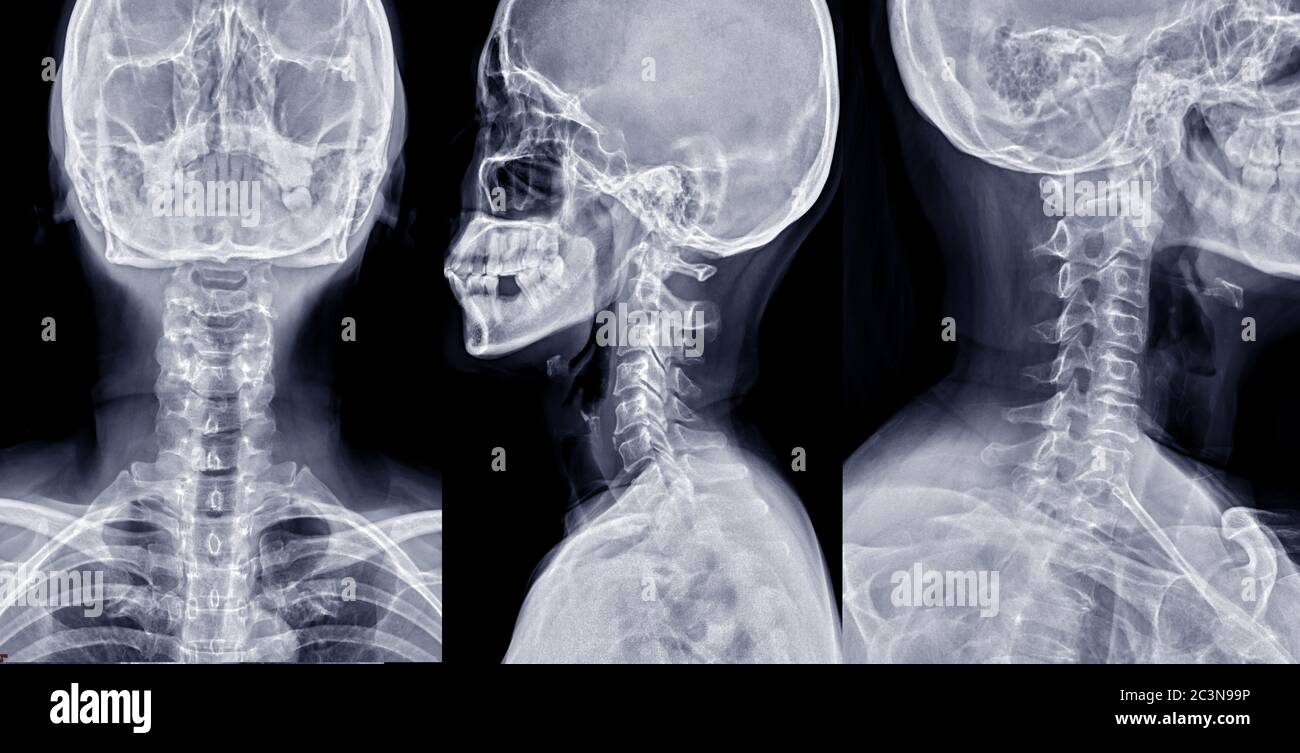 Raccolta di immagini radiografiche della colonna C o radiografiche della colonna cervicale AP , vista laterale e obliqua per l'erniazione diagnostica del disco intervertebrale. Foto Stock
