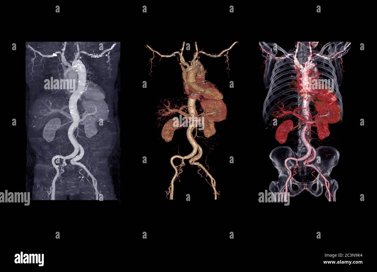 Raccolta di immagini di rendering 3D dell'aorta addominale CTA con dissezione aortica . Foto Stock