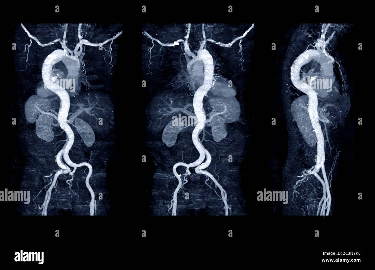 Raccolta dell'aorta CTA con tecnica MPR curva che mostra aorta addominale e arteria iliaca sinistra destra che mostra dissezione aortica . Foto Stock