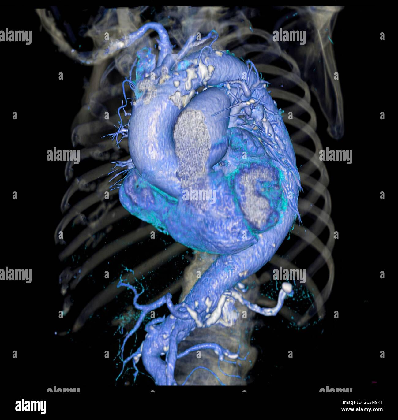 Immagine di rendering 3D dell'aorta toracica CTA per aneurisma aortico addominale diagnostico o per dissezione aortica e AAA Foto Stock