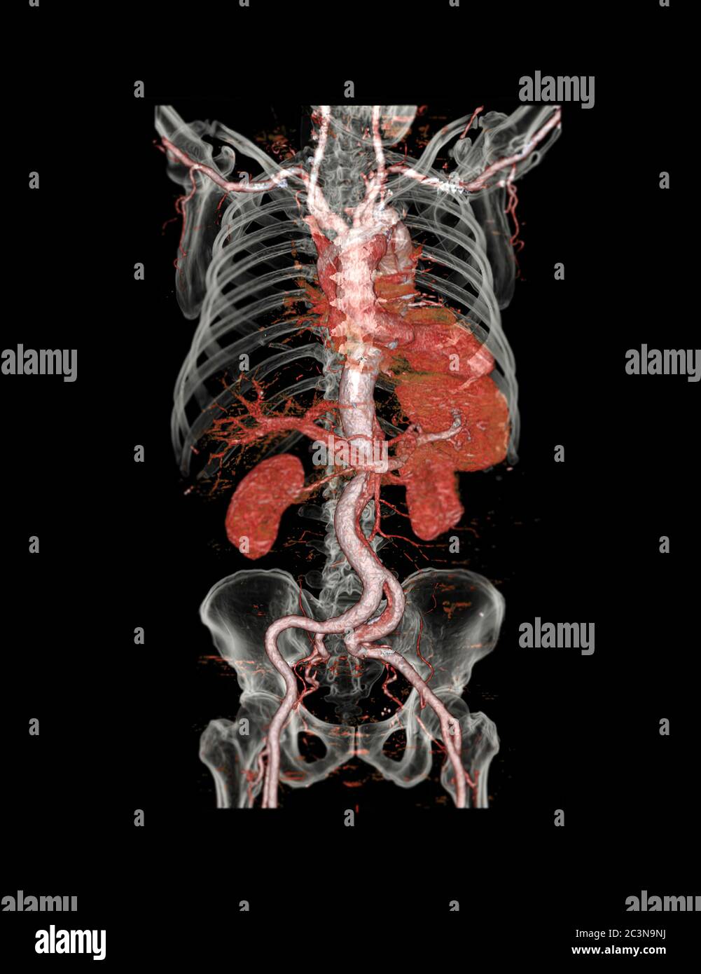 Immagine di rendering 3D dell'aorta addominale CTA che mostra la dissezione aortica con osso trasparente. Foto Stock