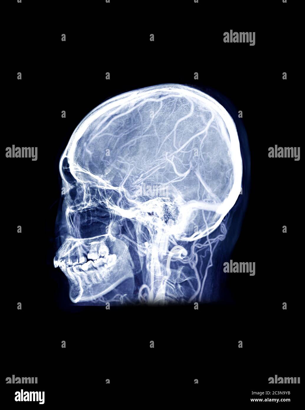 Immagine radiografica del cranio del cranio umano mix laterale MRV immagine cerebrale che mostra i seni venosi del cervello nel cranio. Foto Stock