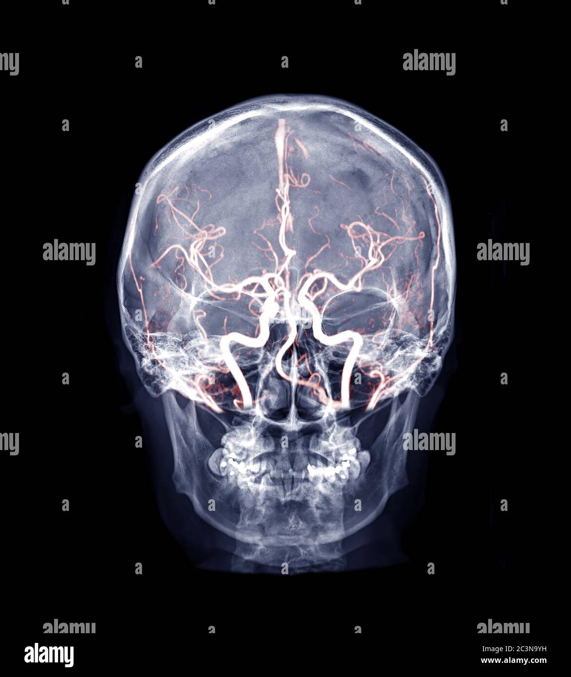 Immagine radiografica del cranio del cranio umano ap mix MRA immagine cerebrale che mostra l'arteria cerebrale del cervello nel cranio. Foto Stock