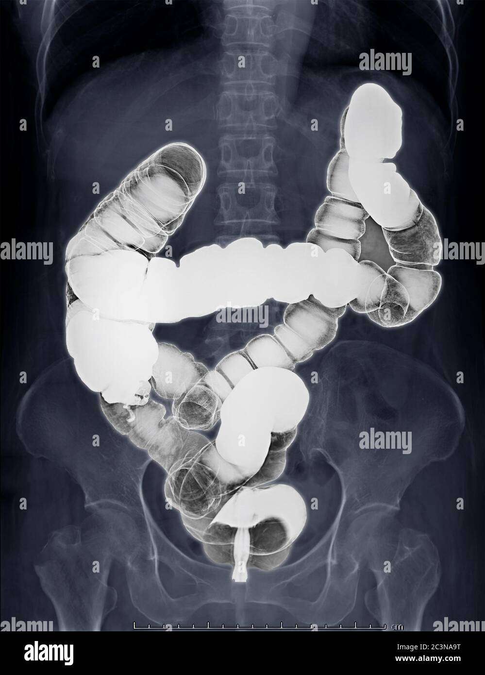 Fuoco selettivo dell'immagine di enema di bario o immagine di raggi X di intestino grande che brilla sull'addome mostrando anatomico del colon per rilevare il cancro del colon . Foto Stock