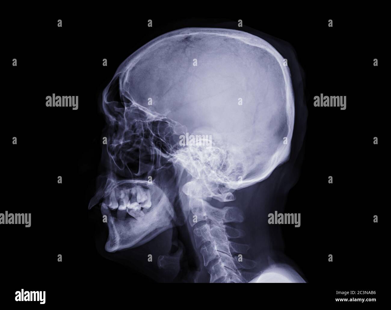 Immagine radiografica del cranio della vista laterale del cranio umano isolata su sfondo nero. Foto Stock