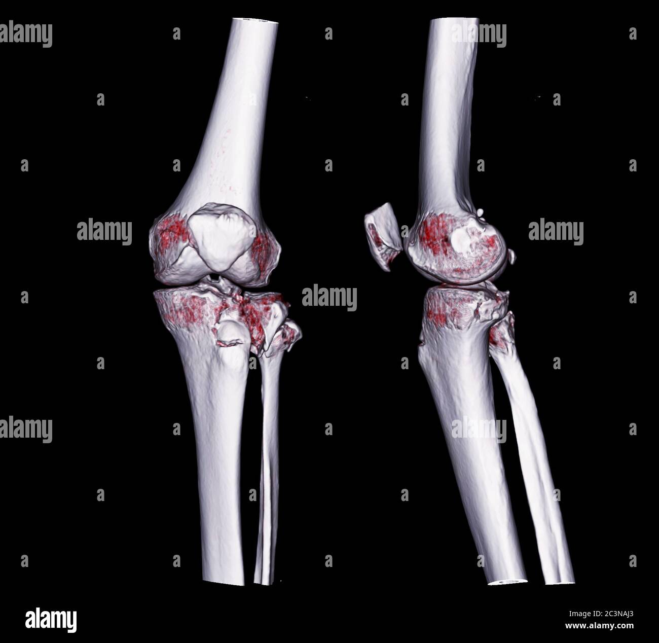 Immagine di rendering 3D del ginocchio TC AP e vista laterale isolate su sfondo nero che mostra la tibia della frattura. Foto Stock