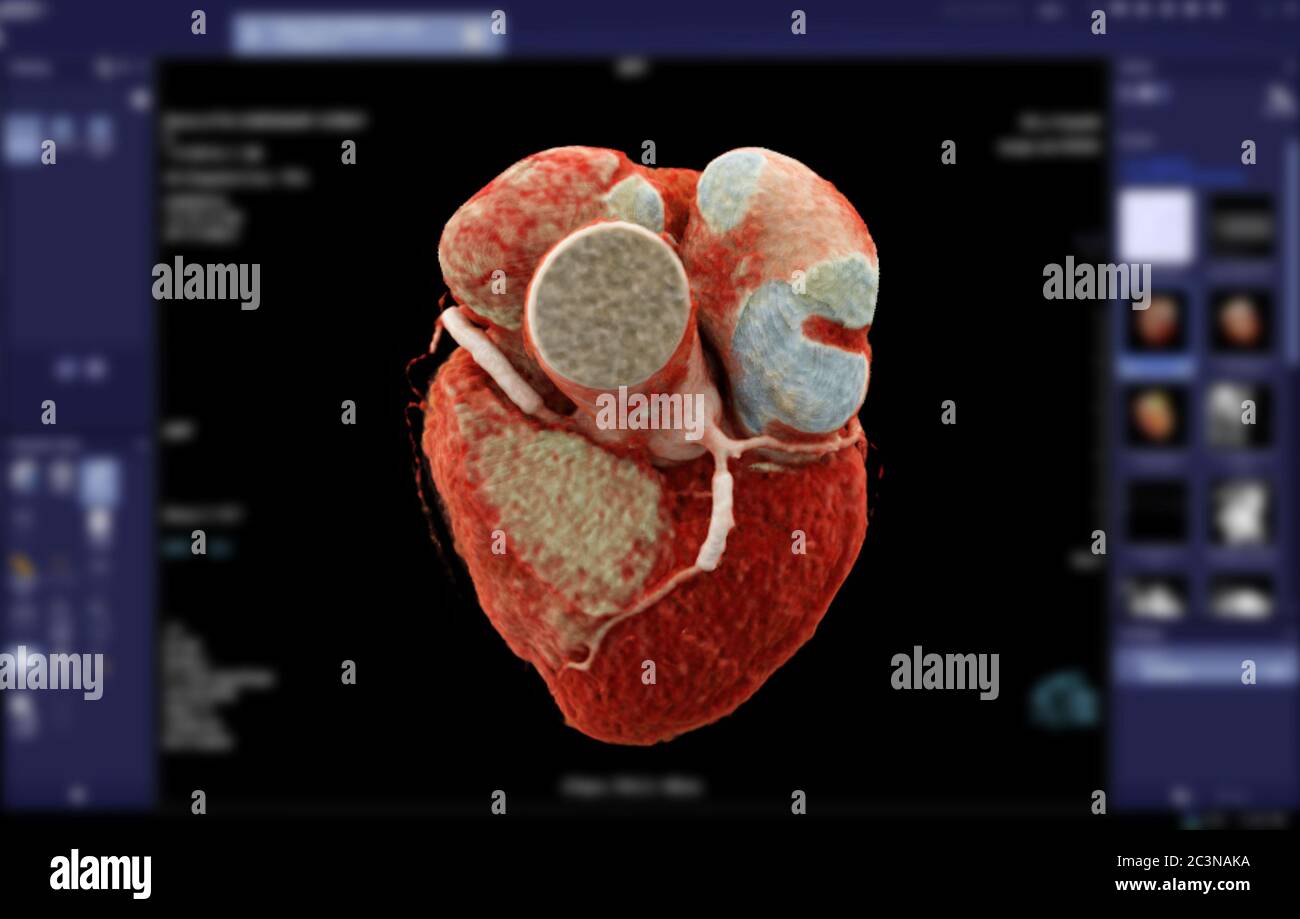 Immagine di rendering 3D dell'arteria coronaria CTA per l'individuazione di coronaropatia su sfondo sfocato dello schermo. Foto Stock