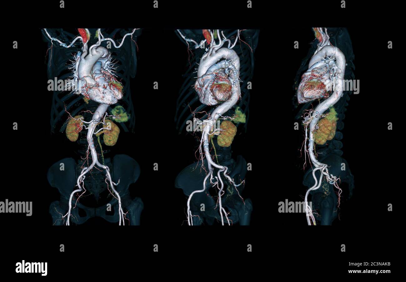 Immagine di rendering 3D dell'aorta intera CTA su sfondo nero per rilevare l'aneurisma aortico. Foto Stock