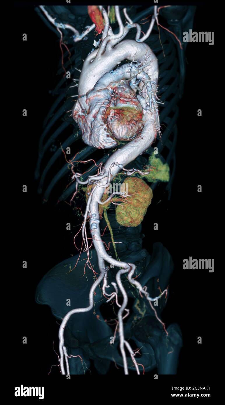 Immagine di rendering 3D dell'aorta intera CTA vista obliqua su sfondo nero per rilevare l'aneurisma aortico. Foto Stock