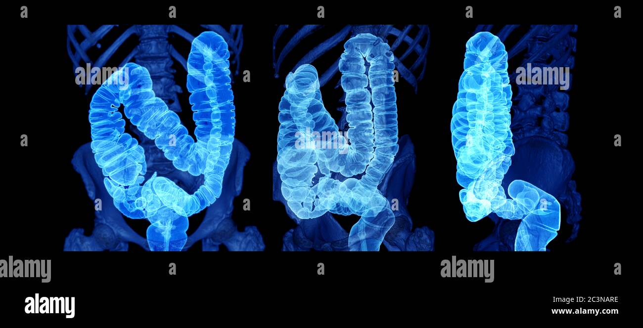 Raccolta di colonografia TC o scansione TC di immagini di rappresentazione 3D del colon che mostrano il colon per lo screening del cancro colorettale. Check up Screening Colon Cancer. Foto Stock