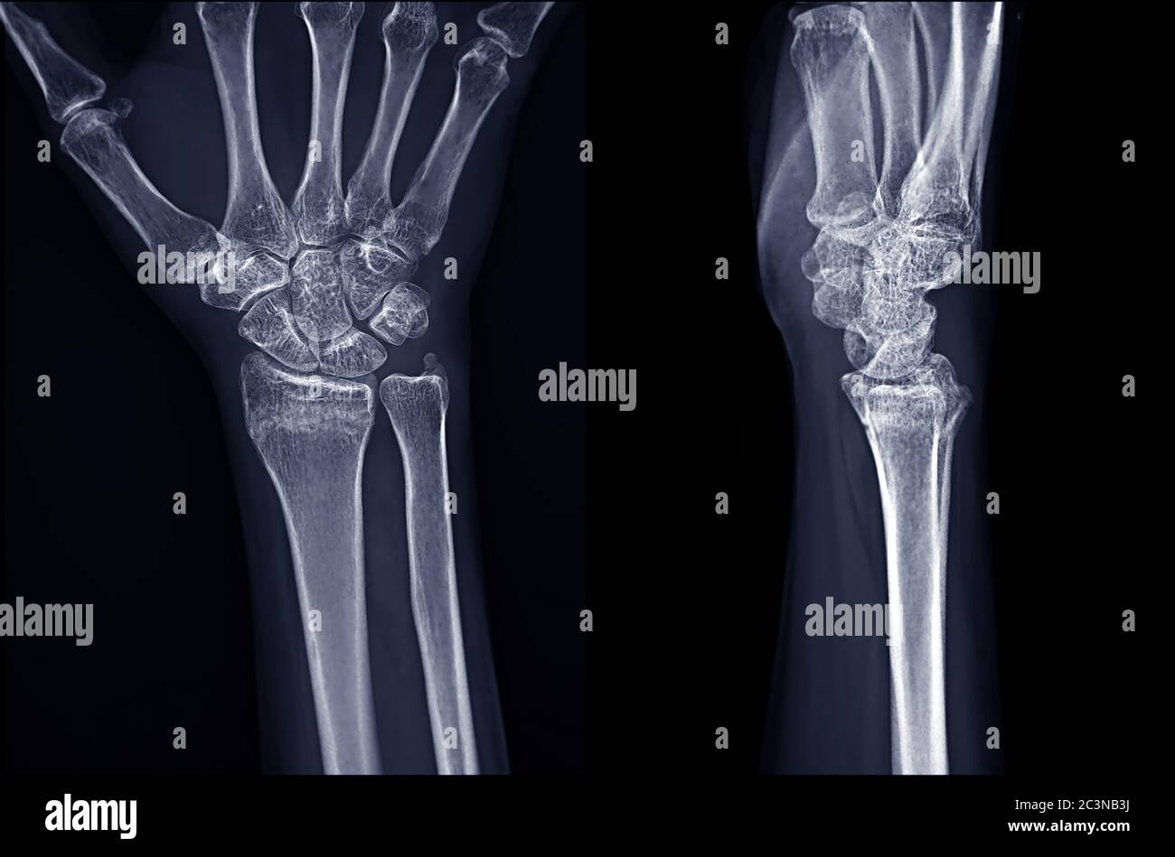 Immagine radiografica dell'articolazione del polso destro AP e vista laterale per la diagnosi dell'artrite reumatoide . Foto Stock
