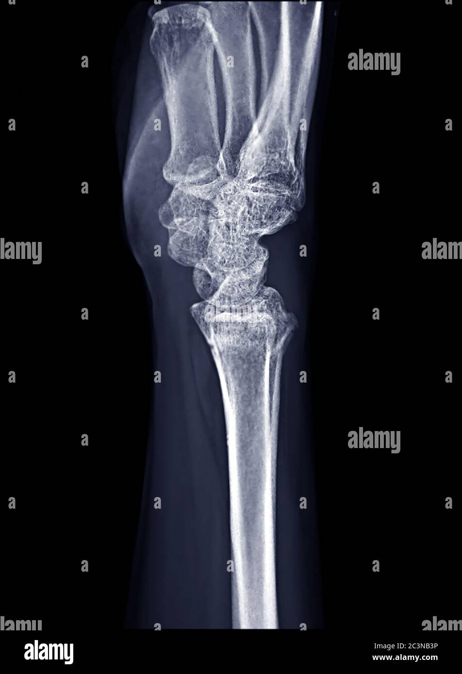 Immagine radiografica dell'articolazione del polso destro Vista laterale per la diagnosi artrite reumatoide . Foto Stock