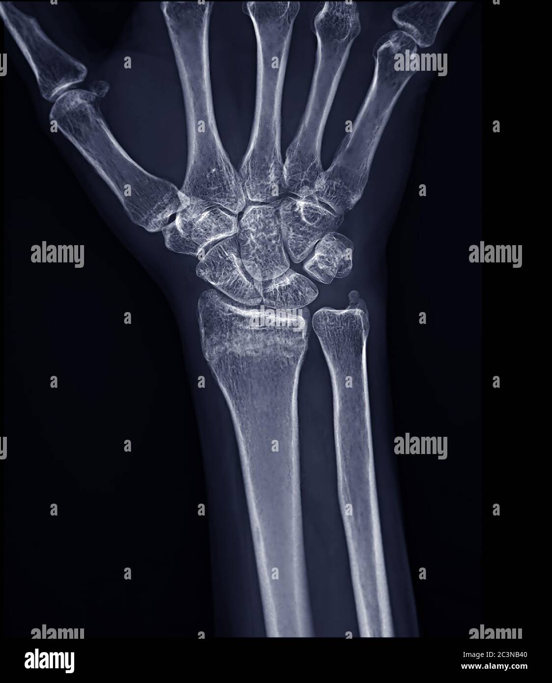 Immagine radiografica dell'articolazione del polso destro Vista AP per diagnosi artrite reumatoide . Foto Stock