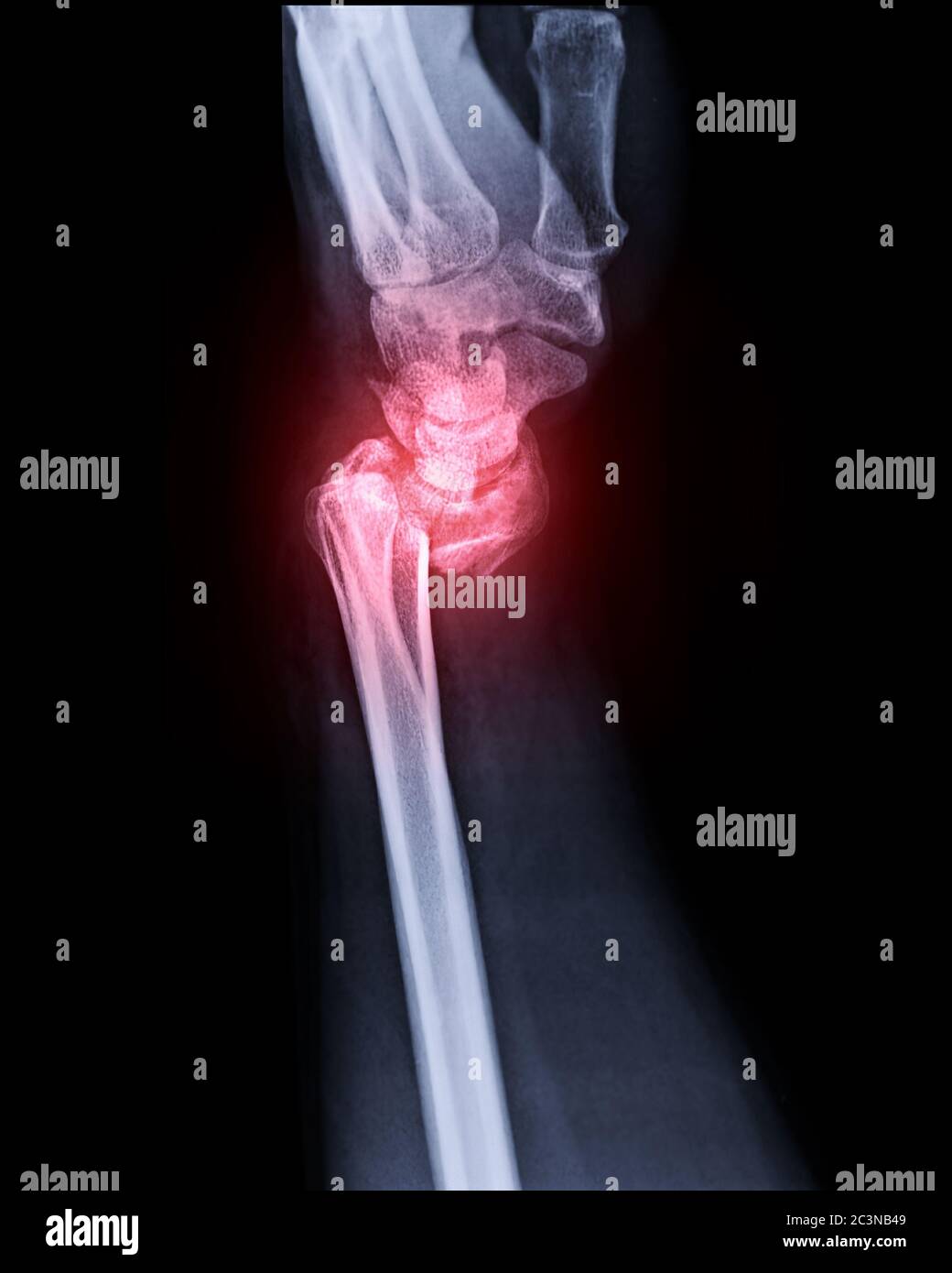 Immagine radiografica dell'articolazione del polso sinistra vista laterale per mostrare la frattura dell'osso radiale. Foto Stock
