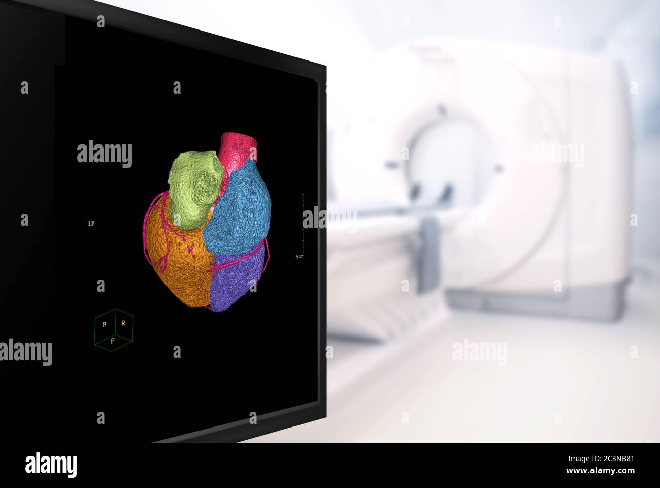 Messa a fuoco selettiva dell'immagine 3D dell'arteria coronaria CTA sul malato nella sala scanner TC dell'ospedale. Foto Stock