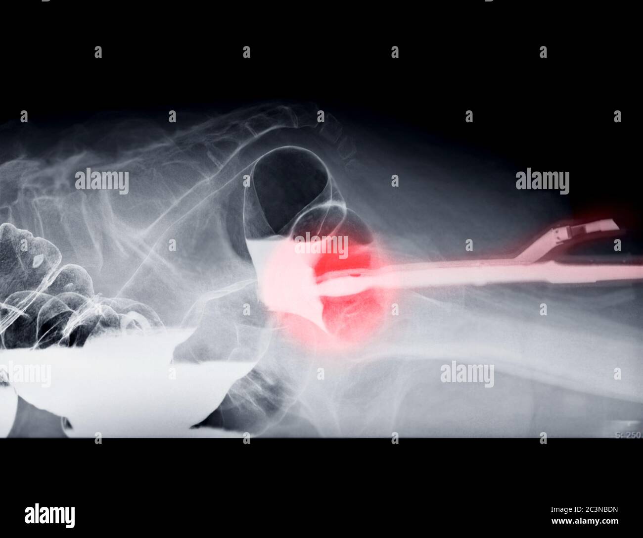Immagine del enema del bario Vista laterale che mostra la punta dell'Enema nel retto del colon sotto controllo fluoroscopico per rilevare il cancro del colon. Foto Stock