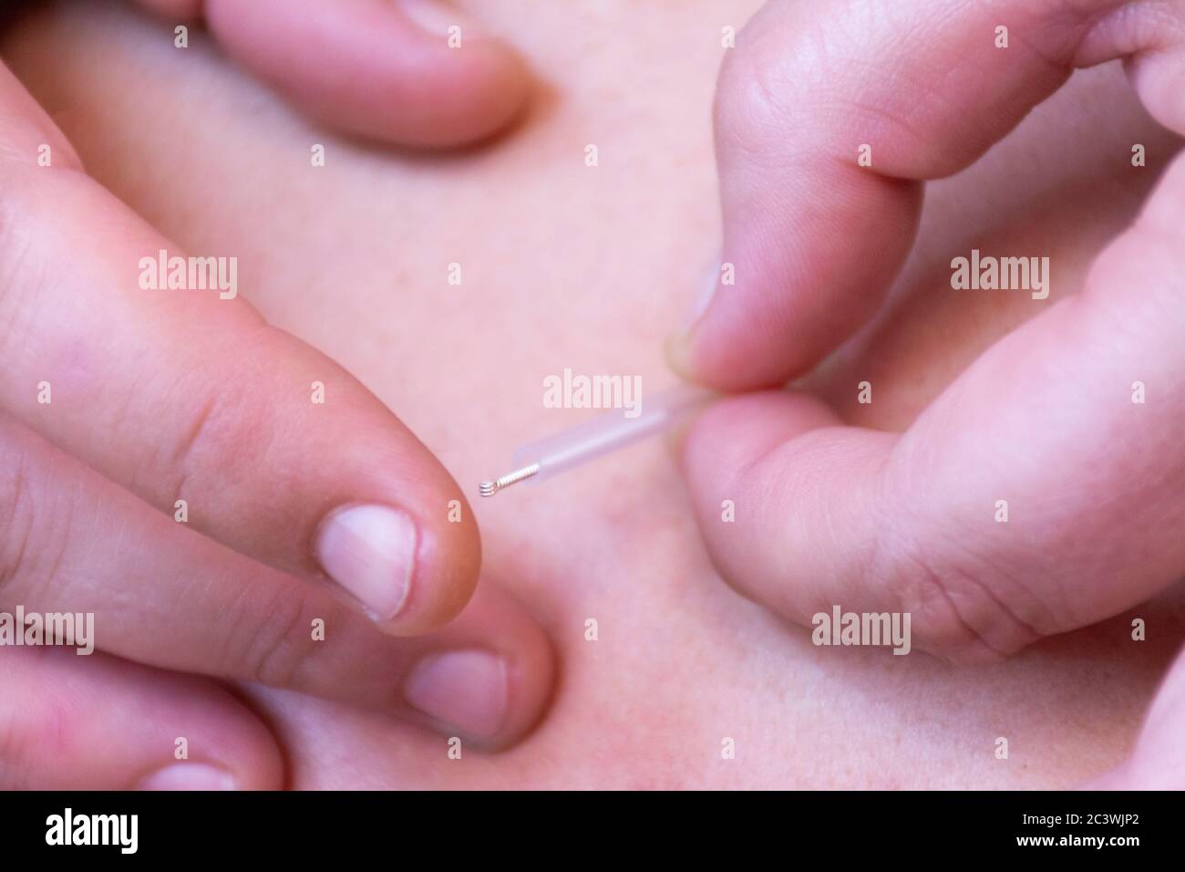 Mani di una donna che mette un ago di agopuntura sulla schiena di una donna. Persone irriconoscibili Foto Stock