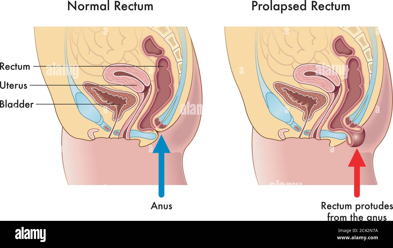 Illustrazione medica che mostra la differenza tra un retto normale e un retto prolasso, con annotazioni che spiegano come ciò si verifica. Illustrazione Vettoriale