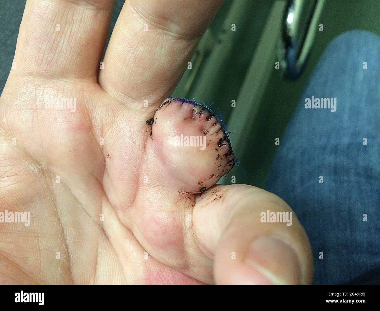 Mano sinistra. Anello dito pupazzare dopo avere un dito amputato, cucito ordinatamente in ospedale. Foto Stock